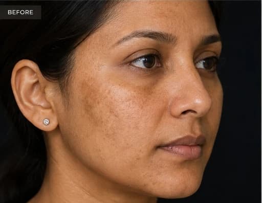 Before treatment intake: Precision Depigmentation Protocol